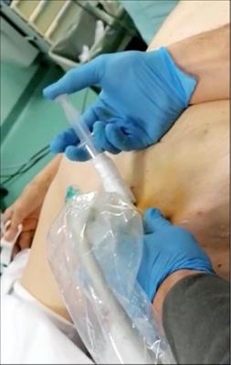 Application of Indocyanine Green Enhanced Fluorescence in Esophageal Surgery: A Mini Review